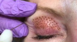 هشدار نسبت به تزریق ژل و چربی در آرایشگاه ها