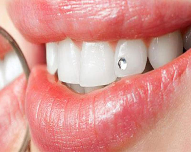 اعمال زیبایی دندان بهطور عمومی توصیه نمیشود اعمال زیبایی دندان بهطور عمومی توصیه نمیشود