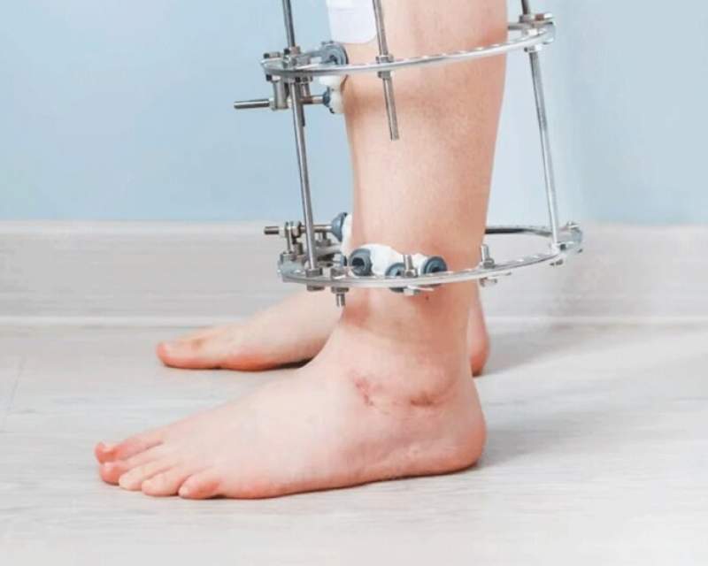 جراحی افزایش قد؛ معجزه یا شکنجه مدرن؟