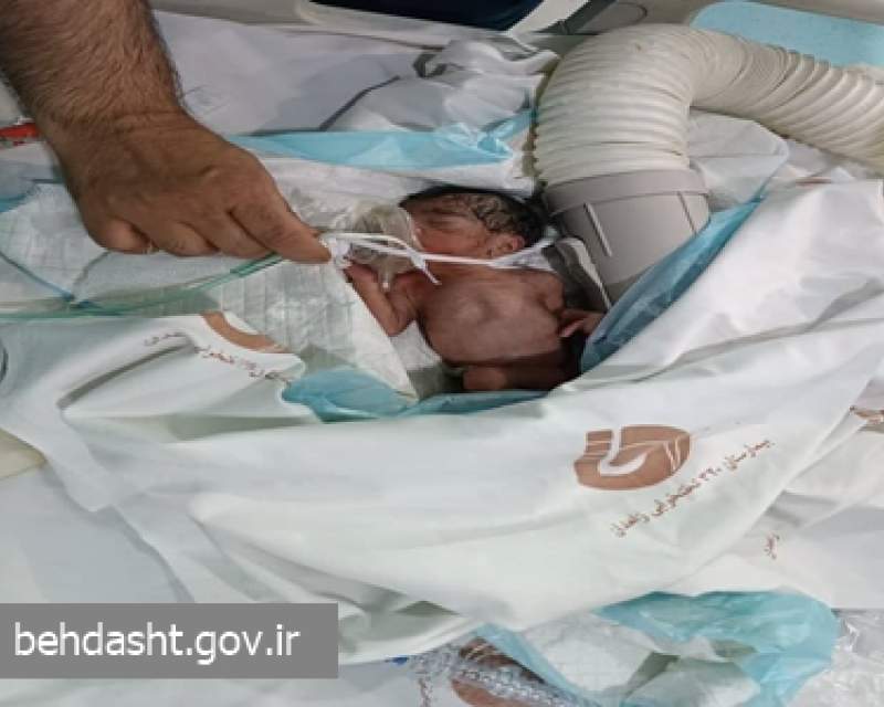 تولد نوزاد بصورت زایمان طبیعی از مادر دچار خونریزی مغزی