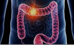 آمار وحشتناک سرطان در مازندران