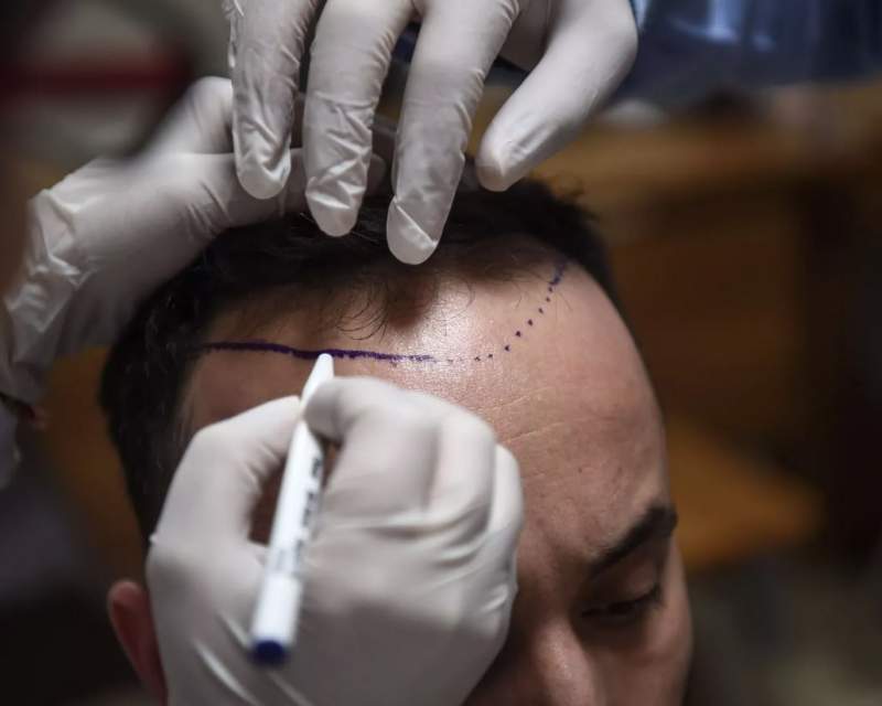 فعالیت ۵۰۰۰ کلینیک غیرمجاز کاشت مو در استانبول!