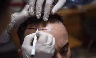 فعالیت ۵۰۰۰ کلینیک غیرمجاز کاشت مو در استانبول!