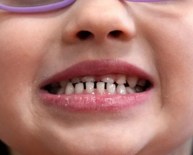 سازمان غذا و دارو آمریکا استفاده از مکمل‌های فلوراید را در کودکان محدود کرد