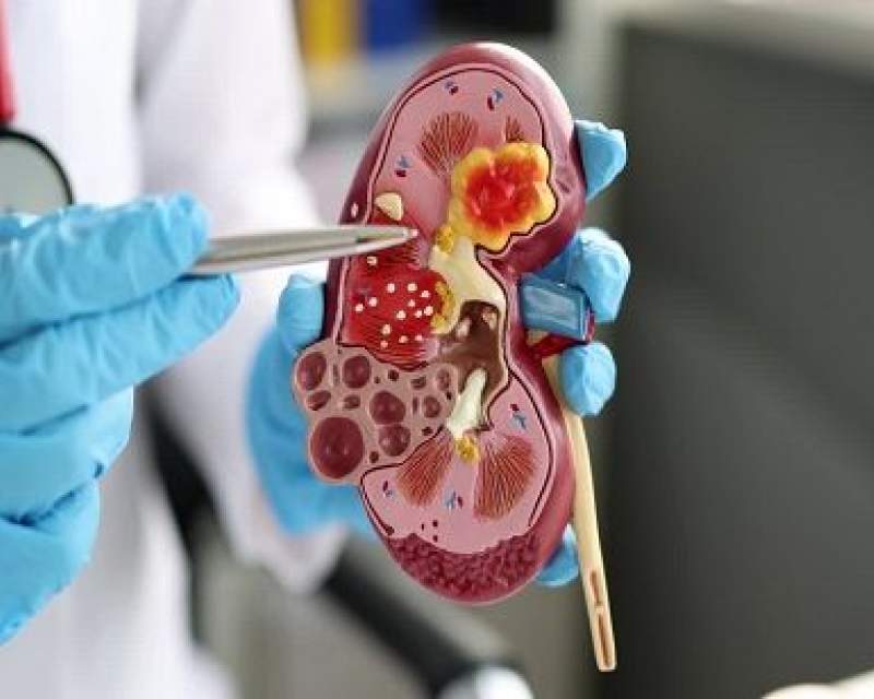 عملکرد امیدوارکننده درمان ترکیبی شرکت‌های مرک و ایسای در بیماران مبتلا به سرطان سلول کلیوی