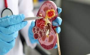 عملکرد امیدوارکننده درمان ترکیبی شرکت‌های مرک و ایسای در بیماران مبتلا به سرطان سلول کلیوی