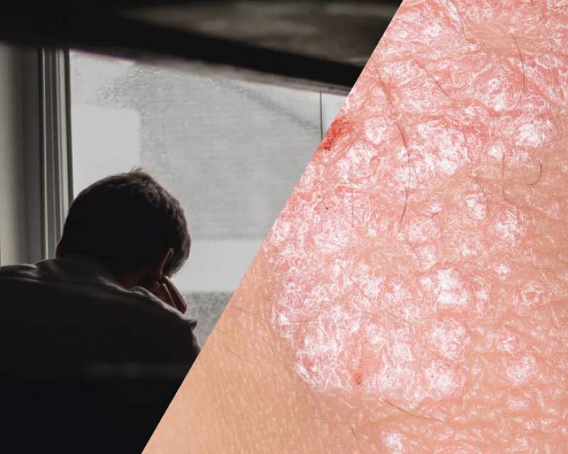 پیوند پوست و روان: مسیرهای مشترک بین پسوریازیس و افسردگی پیوند پوست و روان: مسیرهای مشترک بین پسوریازیس و افسردگی