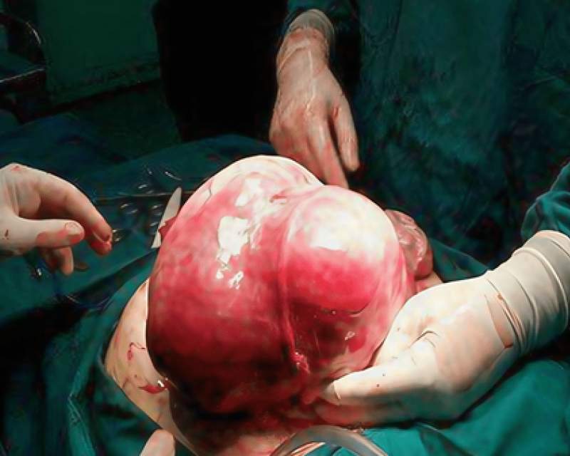 جراحان اردبیلی توده هفت کیلوگرمی را از بدن بیمار خارج کردند