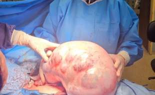 خارج‌ کردن توده ۱۰ کیلویی از شکم یک بیمار در کرج