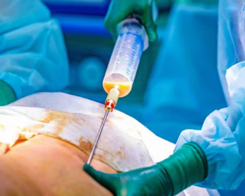 پزشک قلابی در شیراز که در منزل لیپوساکشن میکرد، دستگیر شد پزشک قلابی در شیراز که در منزل لیپوساکشن میکرد، دستگیر شد