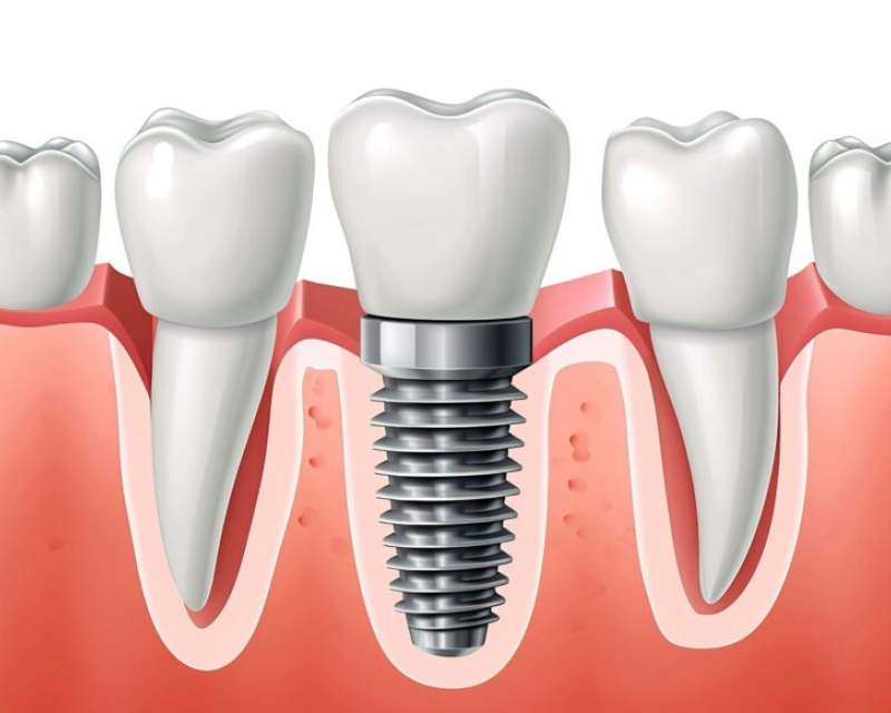 تبلیغ ایمپلنت فوری دروغ است