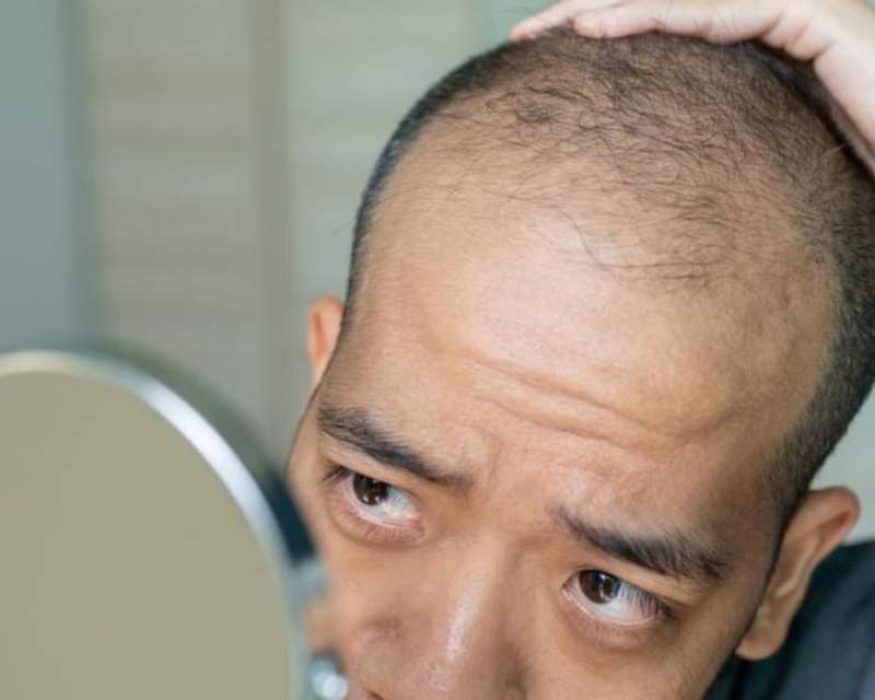 کلاسکوتِرون؛ امید تازه برای میلیونها مرد طاس کلاسکوتِرون؛ امید تازه برای میلیونها مرد طاس