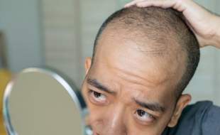 کلا‌سکوتِرون؛ امید تازه برای میلیون‌ها مرد طاس