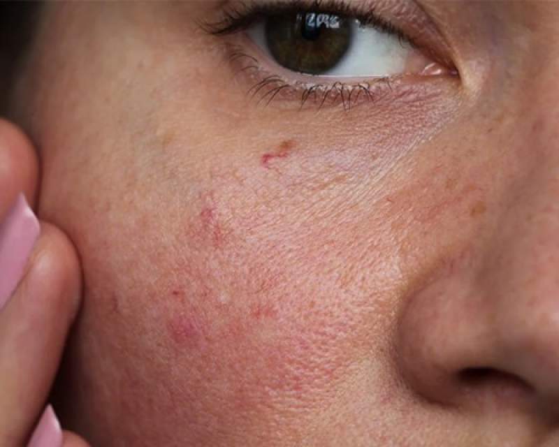 آلرژی‌های ناشی از محصولات آرایشی یک چالش جدی اما قابل پیشگیری