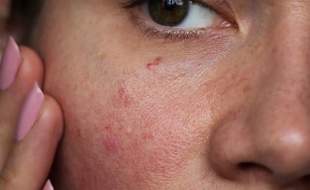 آلرژی‌های ناشی از محصولات آرایشی یک چالش جدی اما قابل پیشگیری